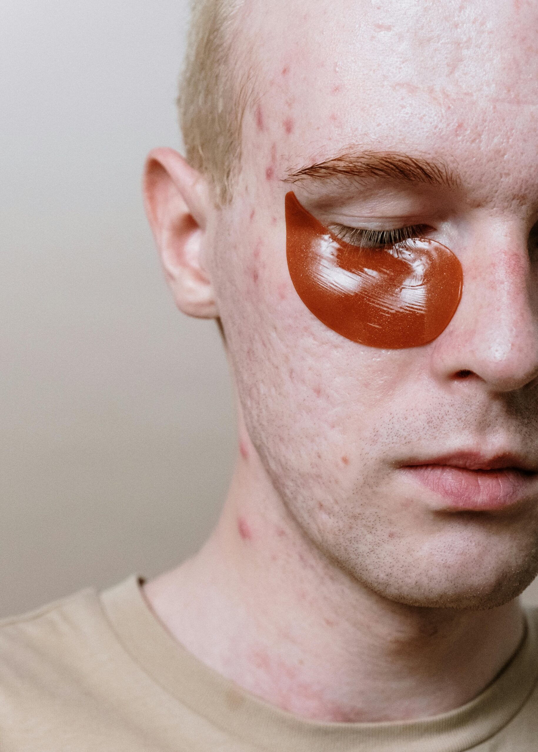 How To Win Your War Against Acne. - Image 3