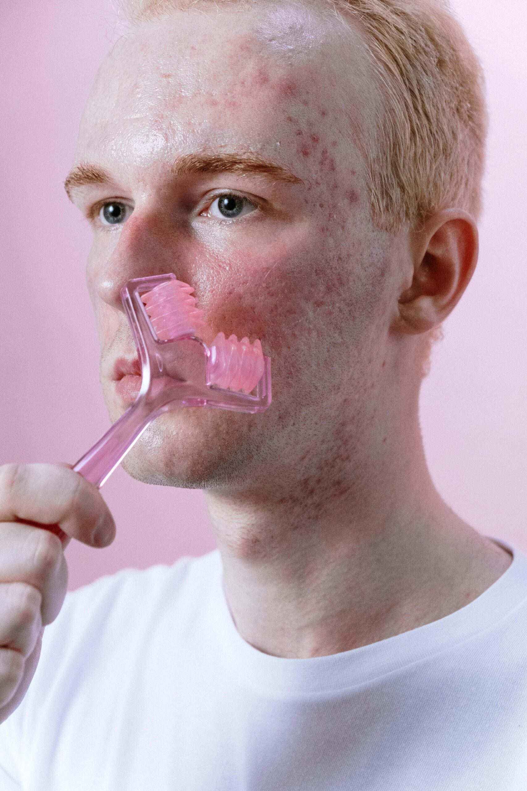 How To Win Your War Against Acne. - Image 5