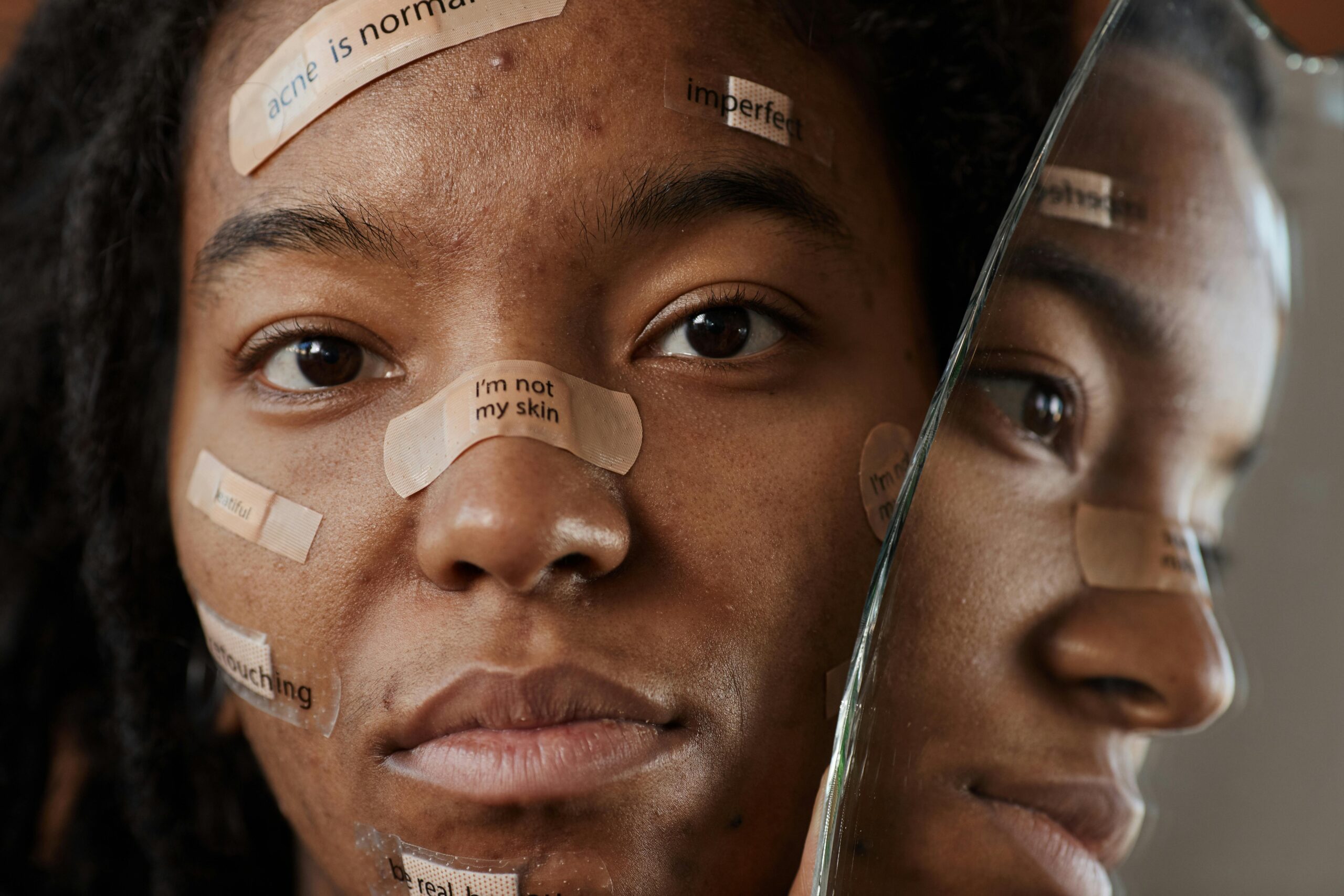 How To Win Your War Against Acne. - Image 4
